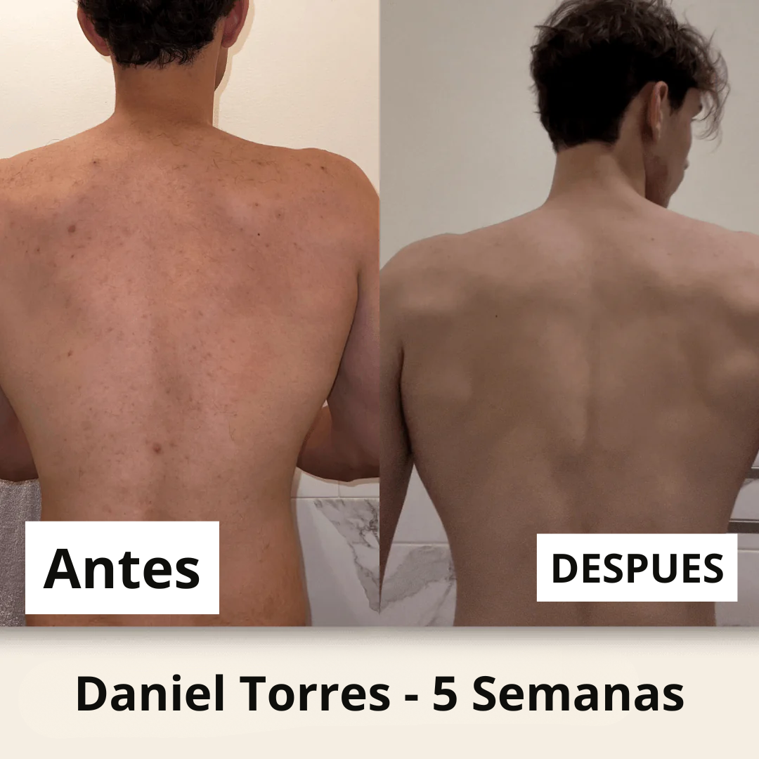 Shield - Jabón Dermatologico para el Acné Masculino