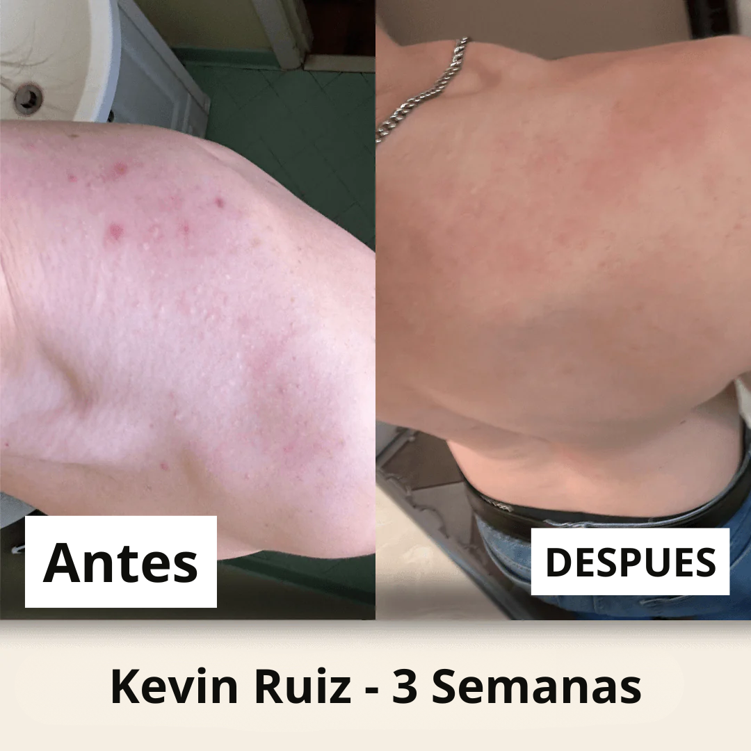 Shield - Jabón Dermatologico para el Acné Masculino